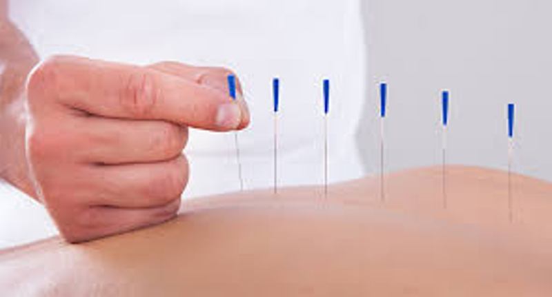 acupuncture 2